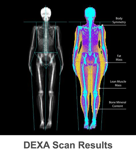 Dexyscan .